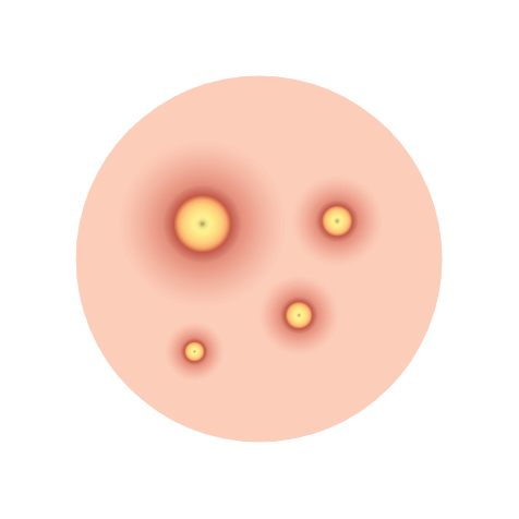 黄ニキビの図